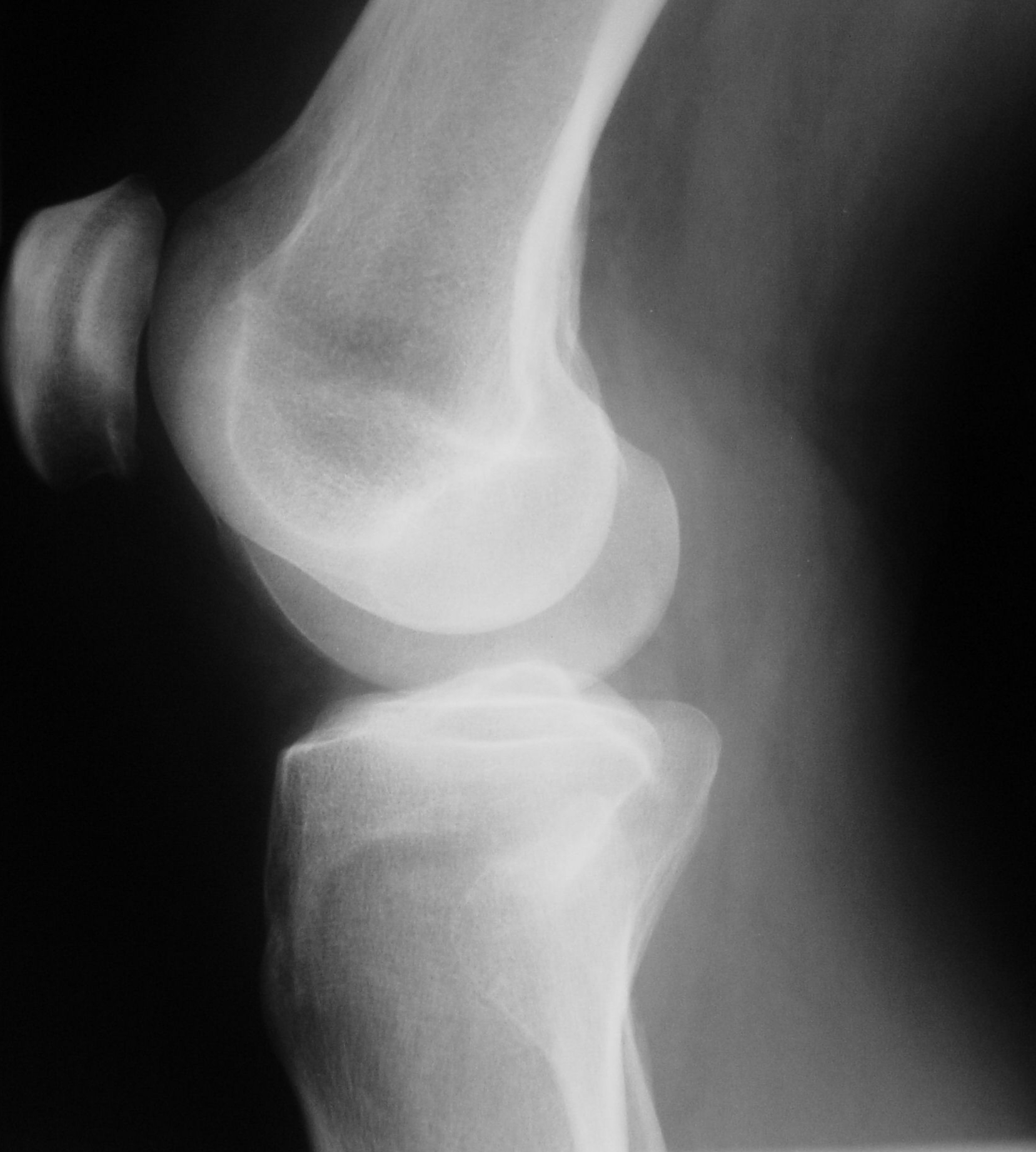 Diagram Diagram Of Tibia Stress Fracture Mydiagram Online